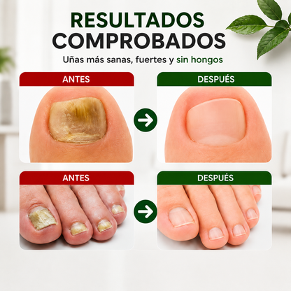 🌿Aceite Anti-hongos Uñas + ¡SOLO POR HOY PAGA 1 Y LLÉVATE 2!🔥
